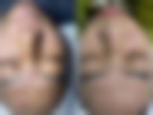 八、厦门爱思特张敏整形真实的患者评价