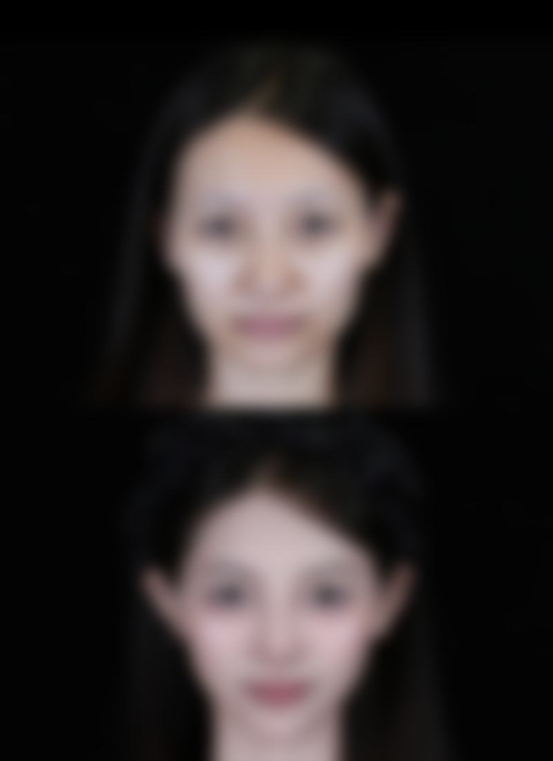 男的去打瘦脸针会不会有尴尬？现代医美助你消除顾虑，自信拥有自然轮廓 