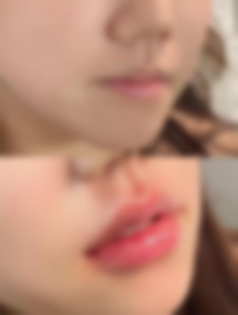 脸上疤痕变红怎么办？其实不用太担心