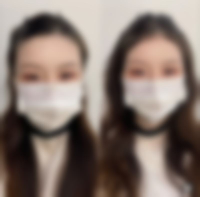 四、长时间熬夜有眼袋，医美干预有妙招