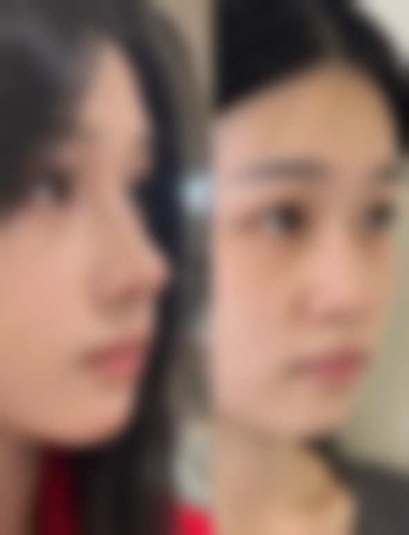 吸脂对身体有什么害处和危害？感染、栓塞等风险及副作用需提前知晓！ 