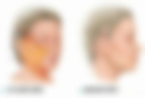 割双眼皮的副作用是什么？了解常见副作用及应对方法，助你安全变美！ 