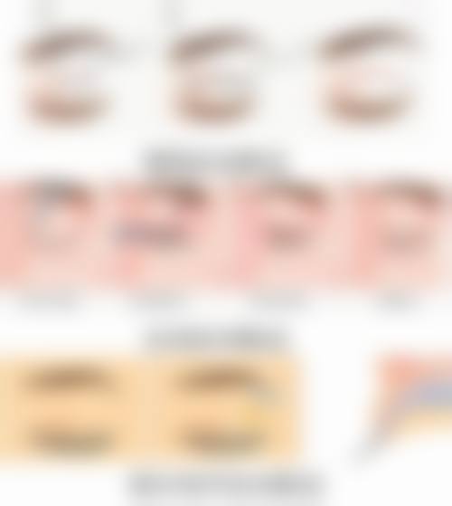 五、为什么单眼皮早上起来会变双眼皮:美观建议及长期维持方案