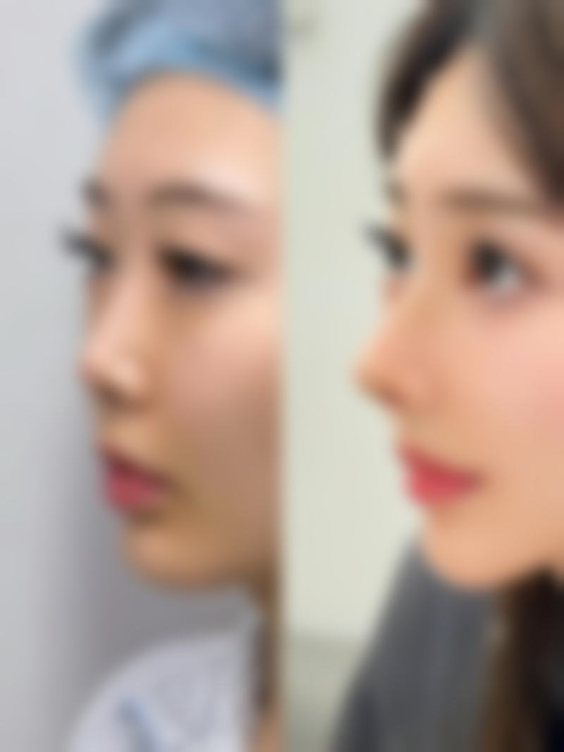 四、从美学角度看割双眼皮及副作用影响