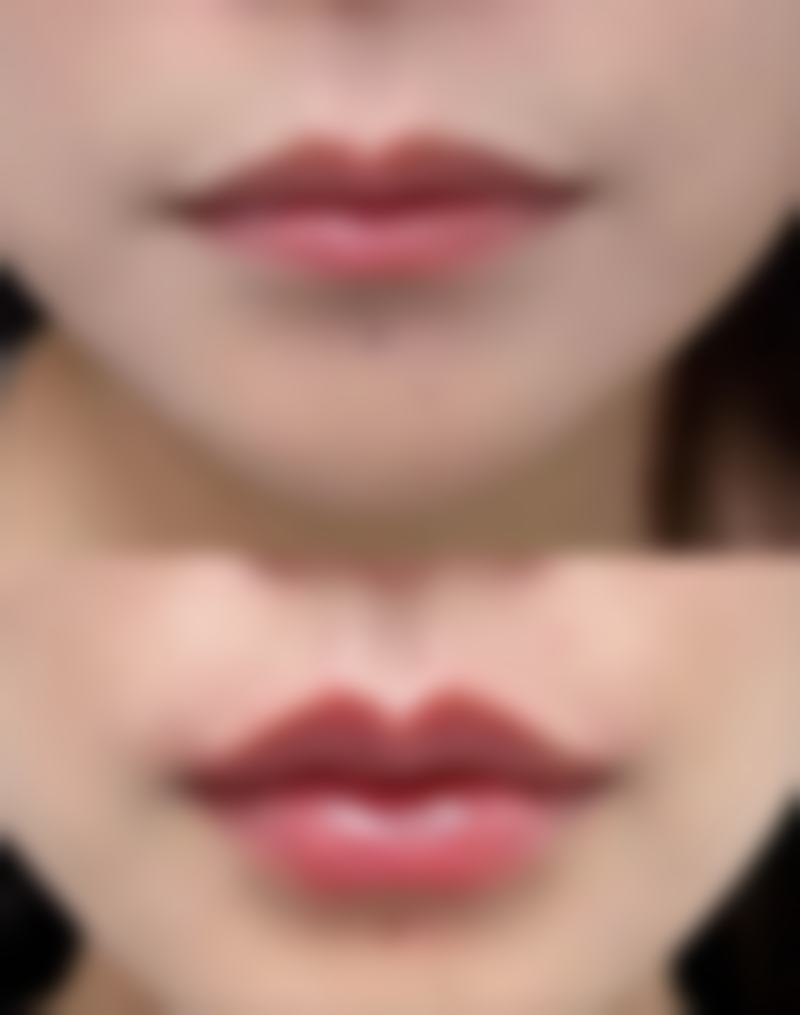 四、为什么单眼皮早上起来会变双眼皮:病理性情况的处理