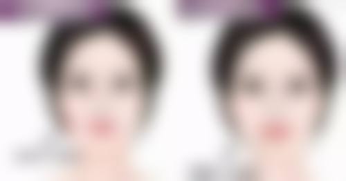 一、埋线双眼皮导致大小眼的原因