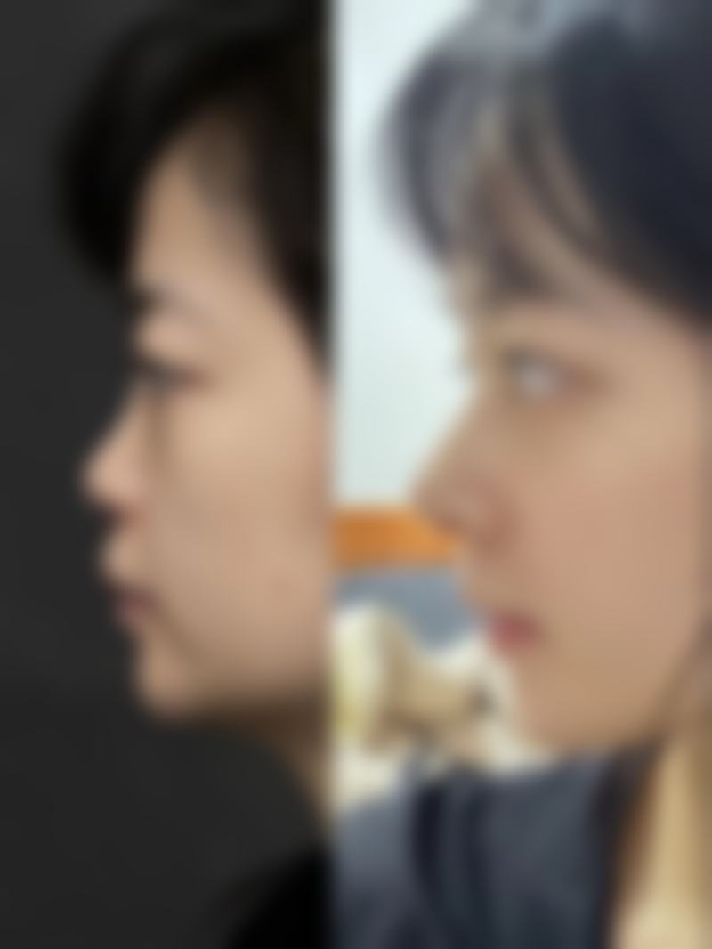 五、点黑点后留下的疤痕修复心态调整