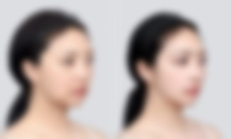 一、双眼皮变不明显的原因