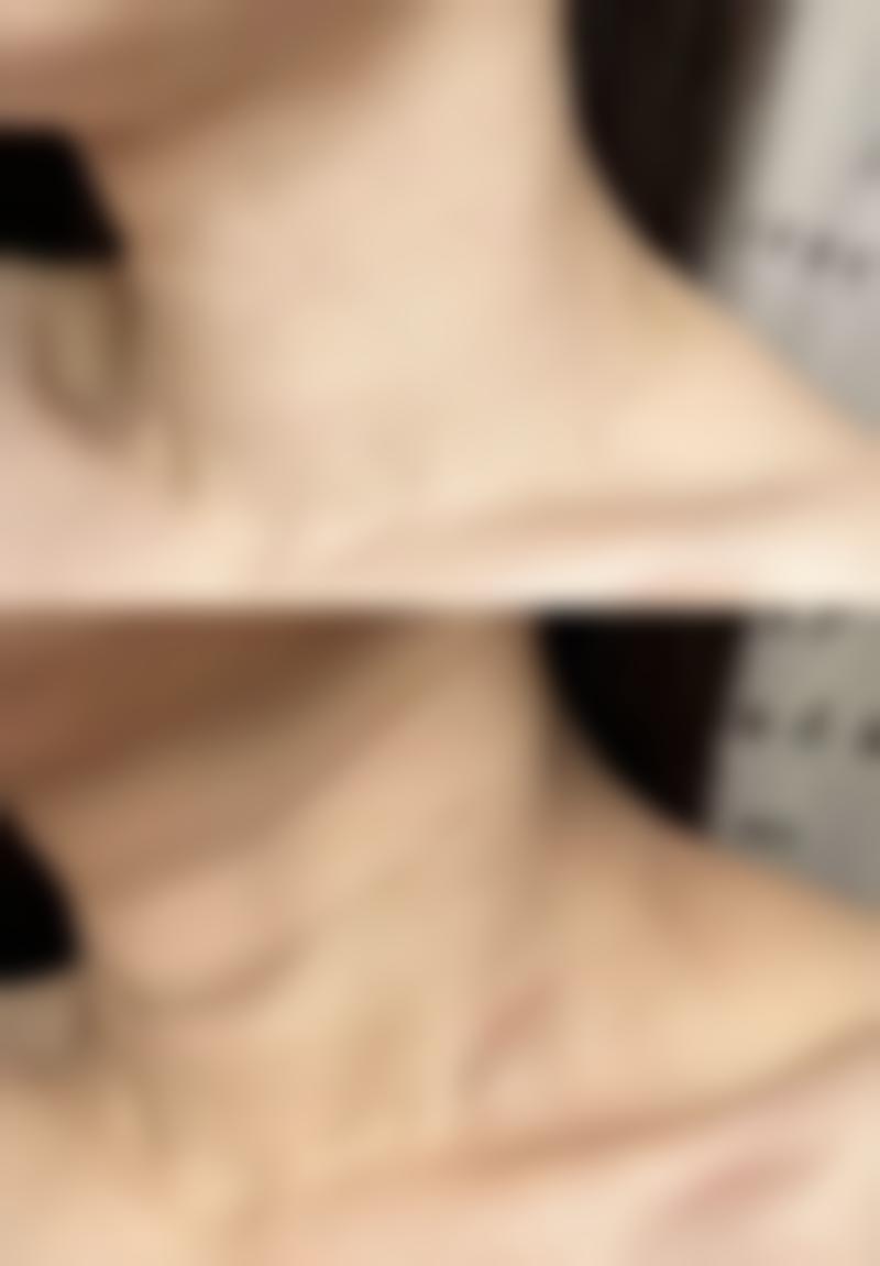 做隆胸手术有什么后遗症？常见风险、应对措施及降低风险建议全揭秘！ 