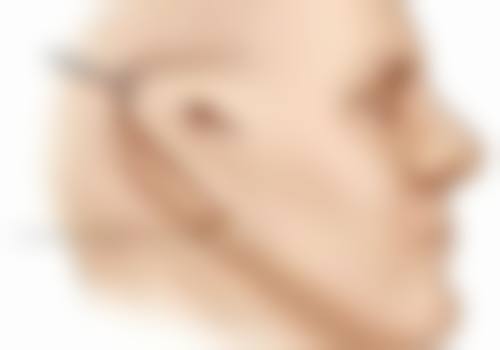 一、1毫升玻尿酸是否够隆鼻的影响因素