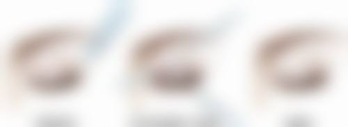 四、玻尿酸隆鼻的其他要点