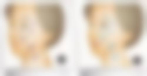 二、做了埋线双眼皮后开眼角的可行性分析