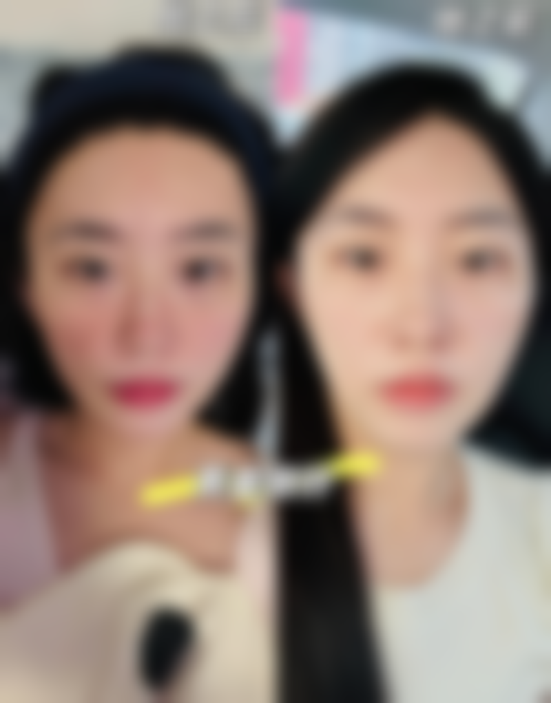 1毫升玻尿酸够隆鼻吗？了解用量与价格因素，开启安全变美之旅！ 