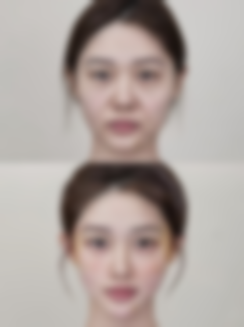 三、热鸡蛋去除眼袋的适用情况