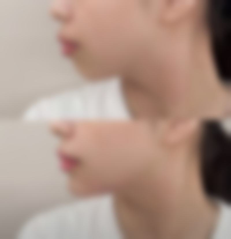 做了埋线双眼皮可以开眼角吗？看完这些图片及分析让你清晰了解手术可行性 