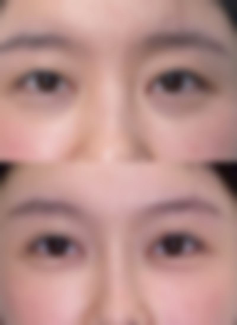 一、怎么样选择隆胸假体之材质篇