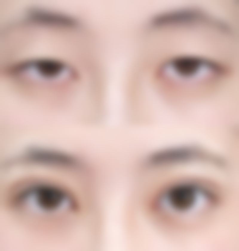 外切导致凹陷可以修复吗眼袋？了解原因、护理及修复方案告别眼部凹陷困扰