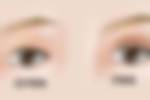 五、手术注意事项