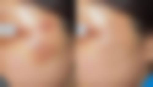 二、5m双眼皮的独特技术