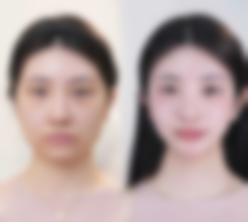 二、脸部吸脂后推荐的食物类型