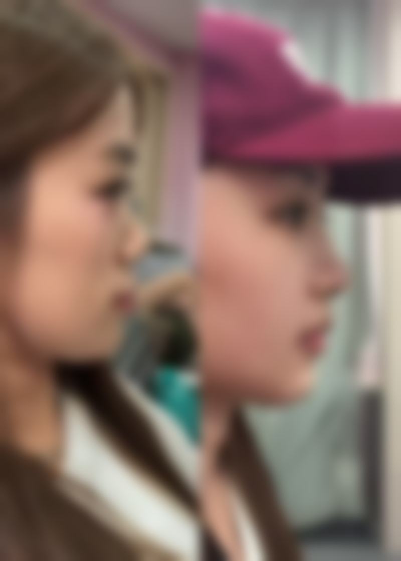 七、5m双眼皮的风险和注意事项