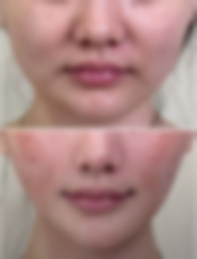 一、肋骨隆鼻修复自然的总体时间