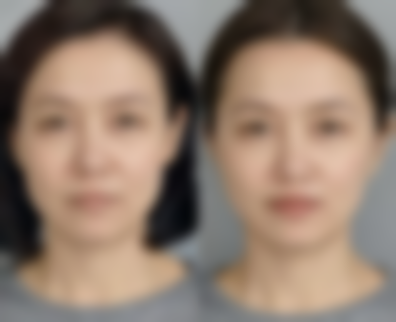 三、可以去烫伤疤痕吗？其他修复方法介绍