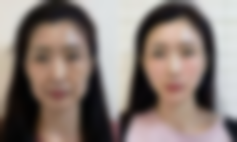 二、眉骨高适合的双眼皮类型