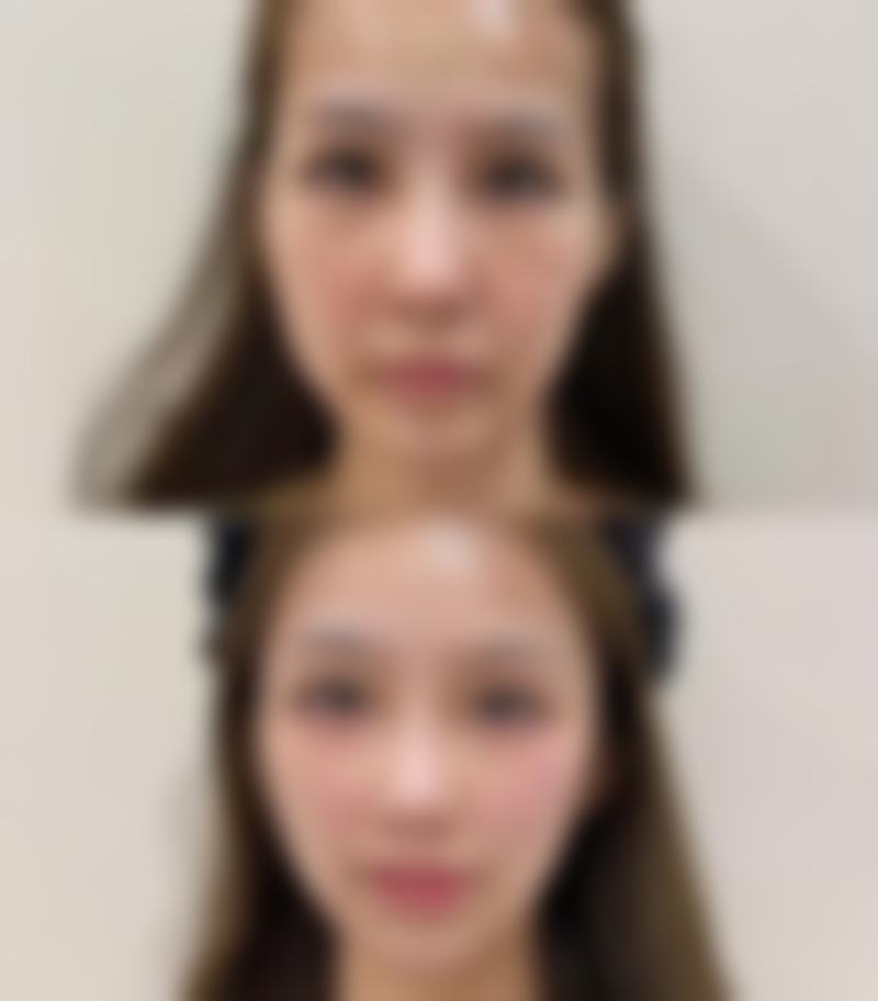 一、烧伤疤痕的常见类型