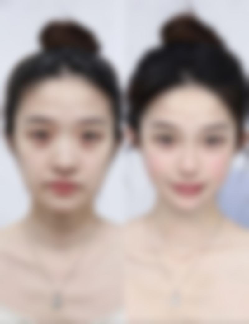 男人眼袋怎么祛除最有效？分型治疗、日常护理结合，多管齐下告别“熊猫眼” 