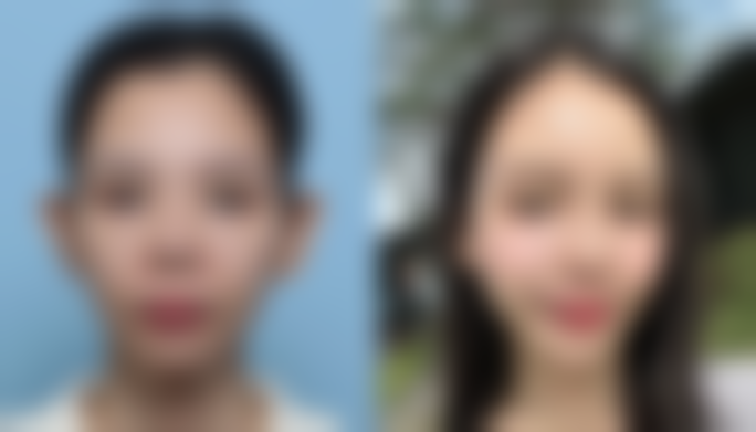 脸上破皮怎么不留疤痕？掌握清洁消毒、防晒护理等要点告别疤痕烦恼！ 