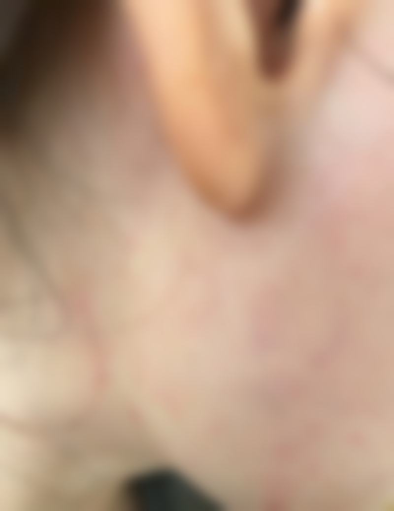 {30岁抗初老，我在广东韩妃找蒋水清主任做半岛超声炮，效果好恢复快太值了