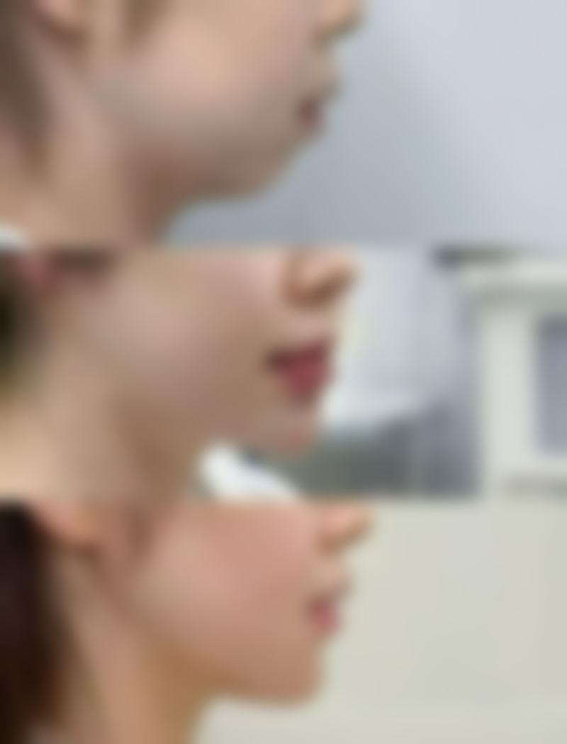 眉骨高做双眼皮好看吗？总结与建议