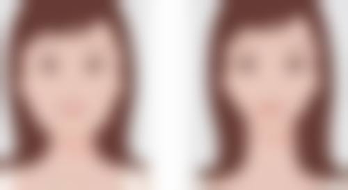 一、双眼皮手术维持时间总体情况