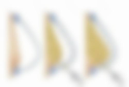 五、术后注意事项