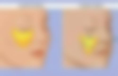 三、不同术式的维持时间对比