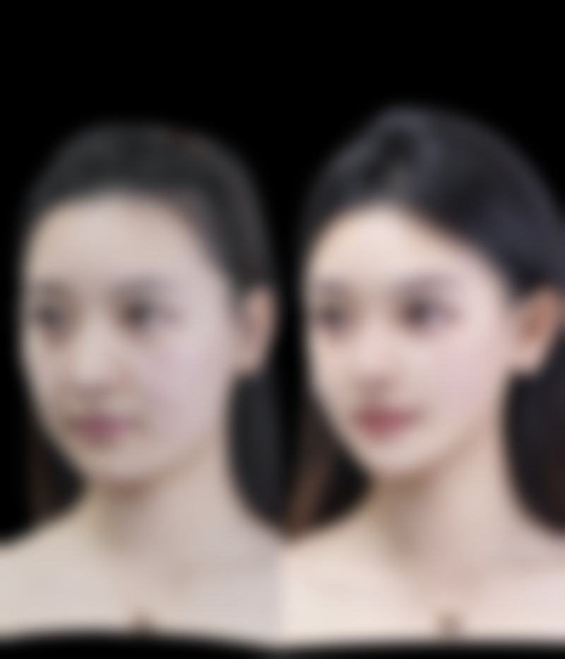 三、腹部吸脂的常见方法