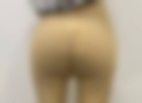 五、其他影响割双眼皮修复时间的因素