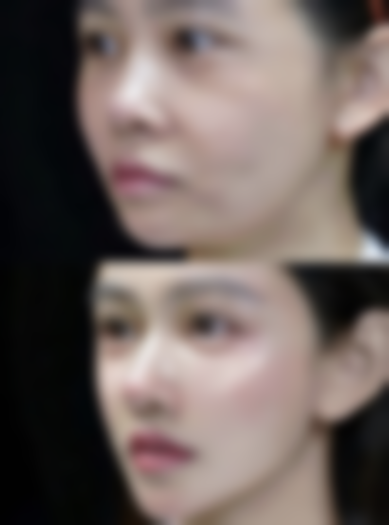 二、术后不同阶段的眼部活动建议