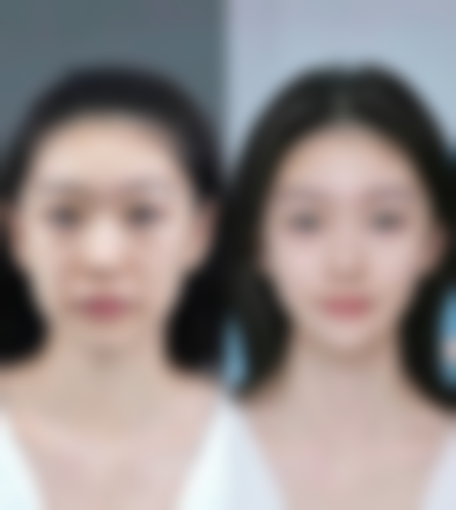 二、手术方式对割双眼皮修复时间的影响