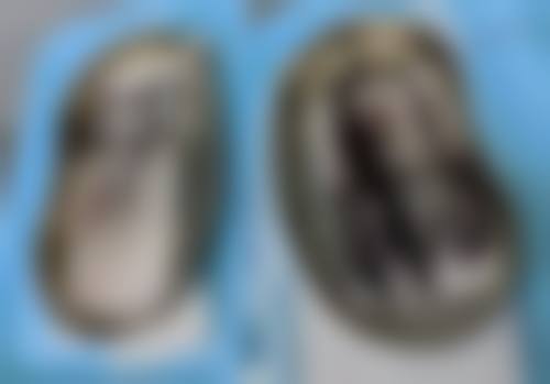 四、手术切除眼袋后遗症的影响因素