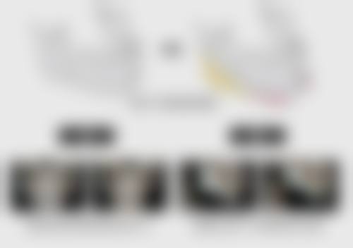 二、不同吸脂技术对比