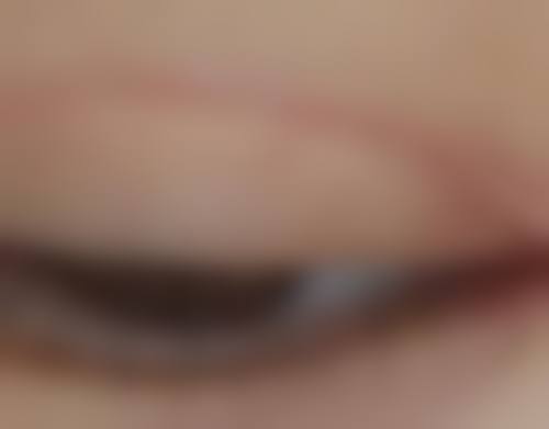 四、假体植入隆胸安心吗之术后护理要点