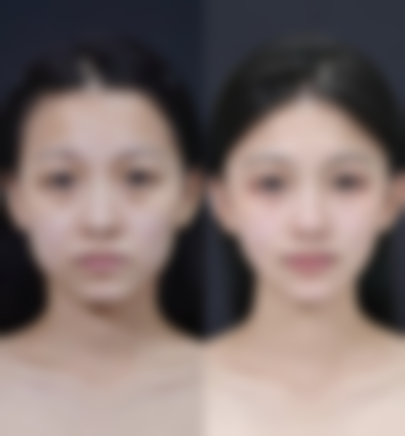 三、激光治疗疤痕增生的注意事项