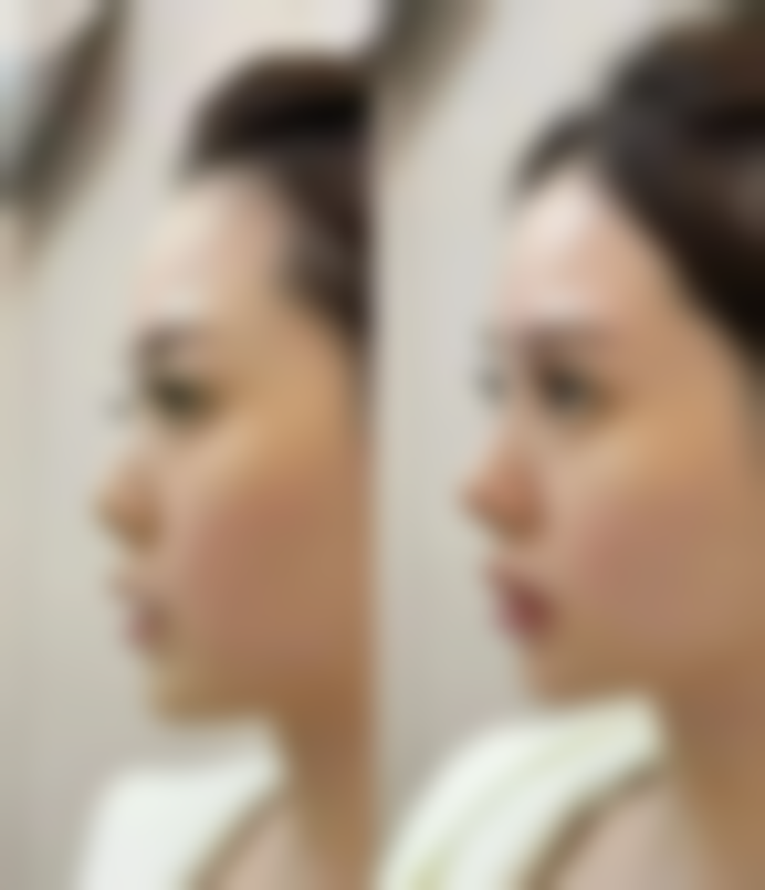 疤痕增生激光可以去掉吗？了解激光祛疤原理与效果，助你改善疤痕外观