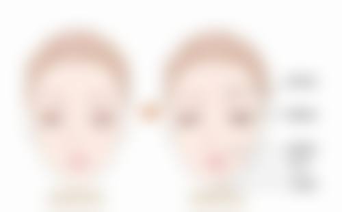 二、阴道紧缩术的至佳时机