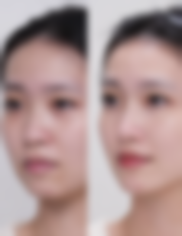 六、正确看待假体隆胸