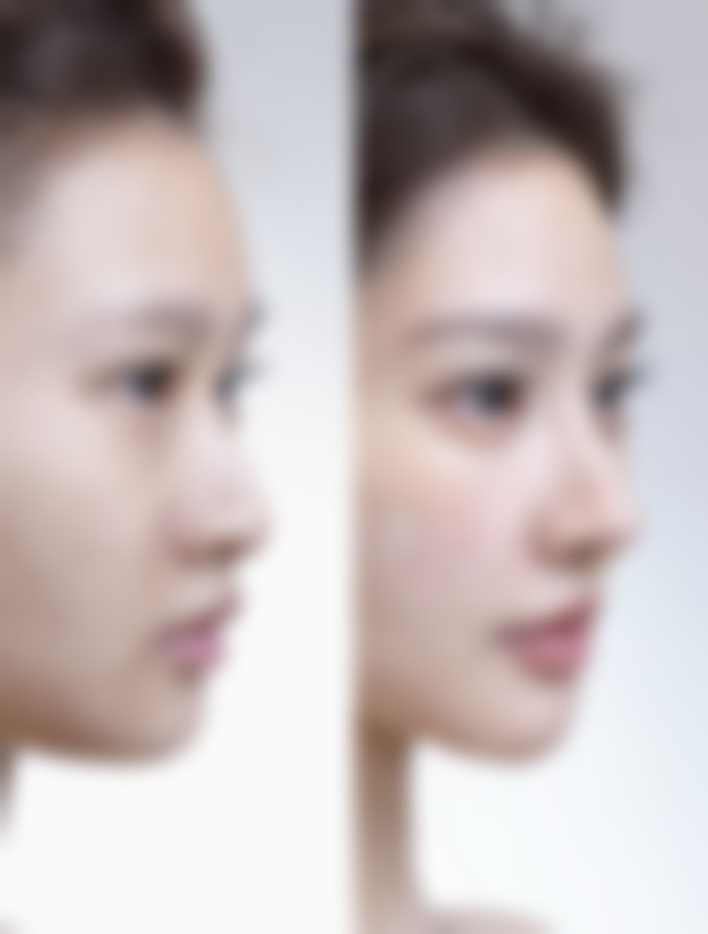 一、哺乳期做阴道紧缩术的风险