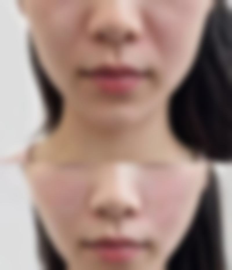 三、哺乳期阴道松弛的替代改善方案