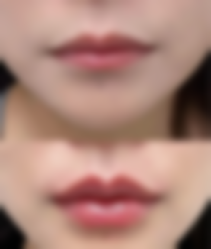 四、阴道紧缩术的注意事项